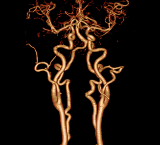 Carotid Arteries and Circle of Willis Study